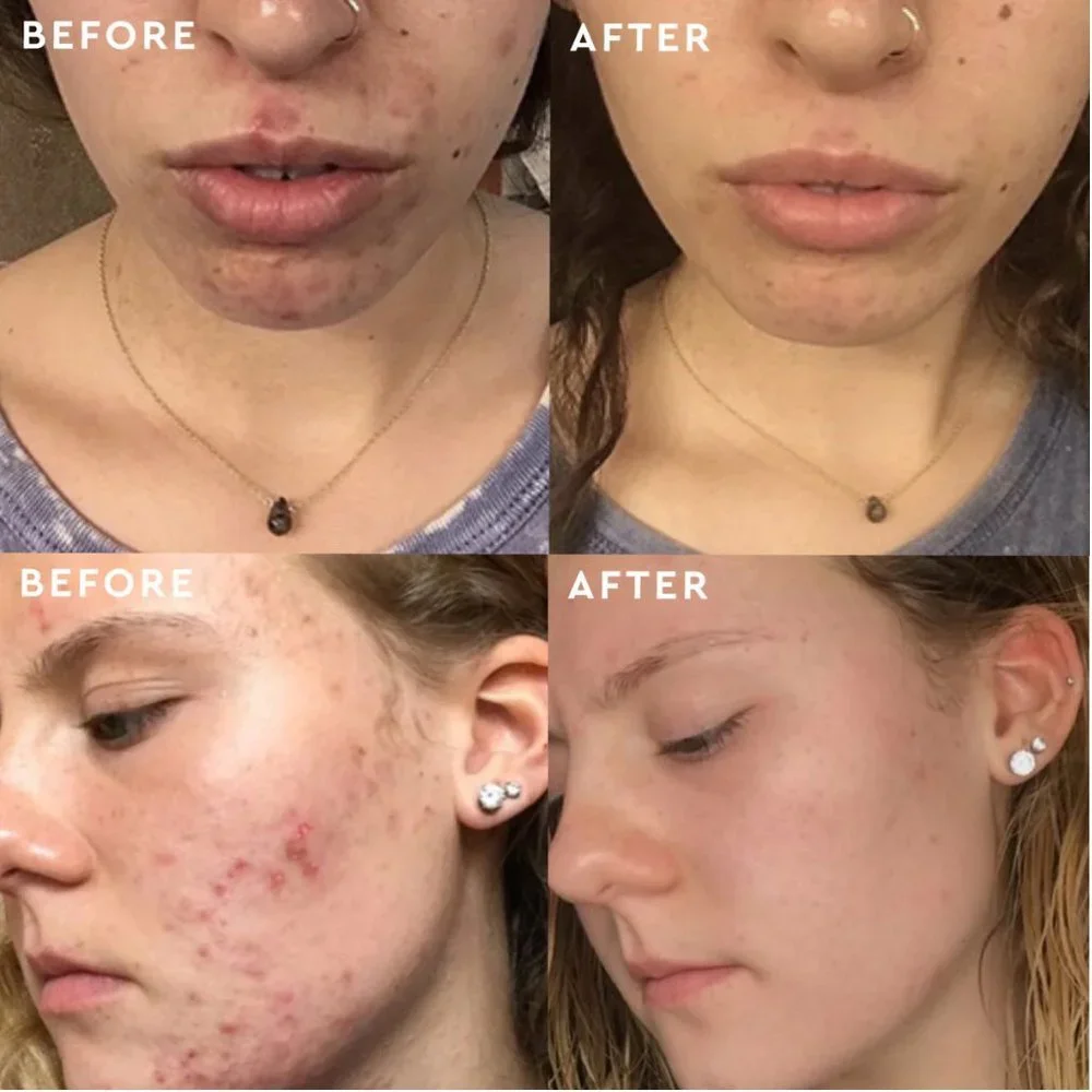 🌸 NWT bioClarity Clear Skin Routine for Acne Prone Skin (4 piece kit) NIB